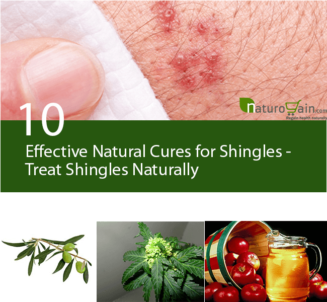 10 Effective Natural Cures for Shingles