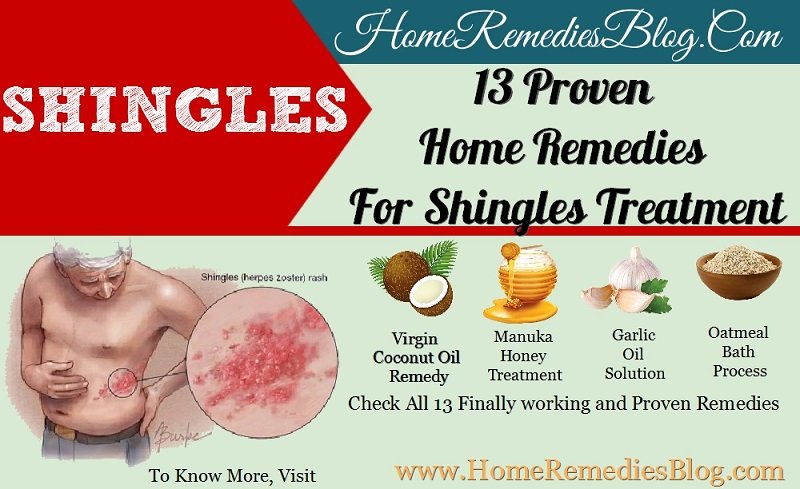 13 Powerful Home Remedies For Shingles Treatment