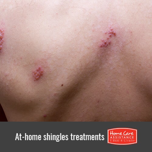 5 Ways to Treat Your Senior Loved Oneâs Shingles Pain
