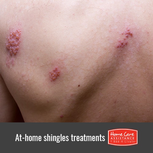 5 Ways to Treat Your Senior Loved Ones Shingles