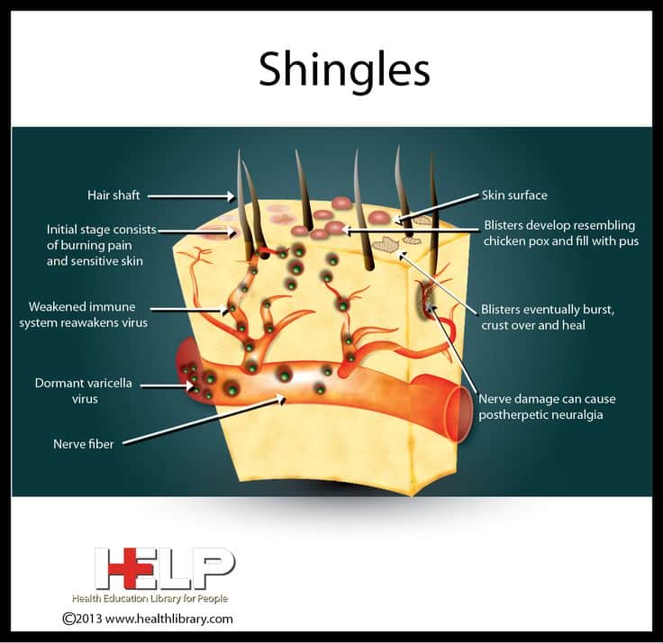 55 best images about treating shingles on Pinterest