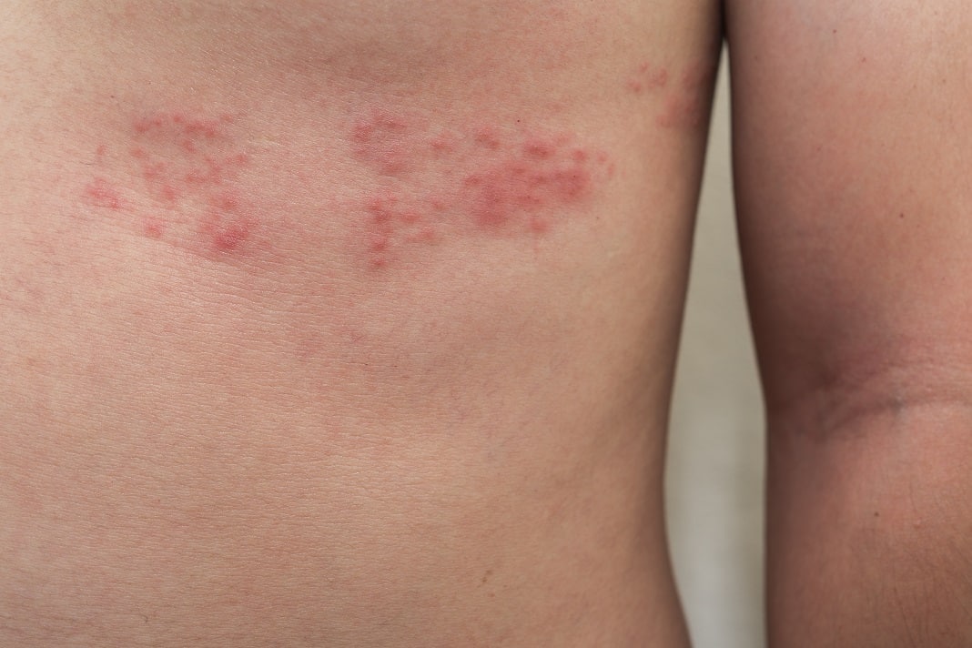 6 Foods To Avoid With Shingles: Measures To Prevent