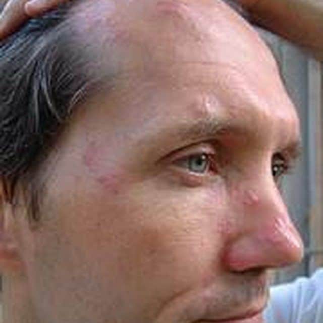 A mild shingles rash on the face.