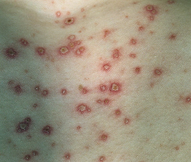 Adult Chickenpox Pictures  39 Photos &  Images / illnessee.com