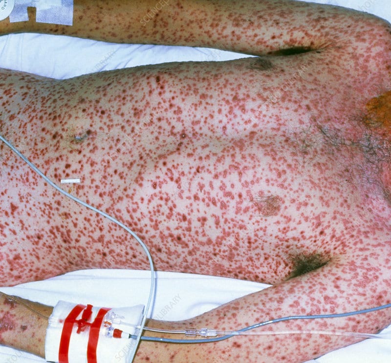 Adult with severe chickenpox