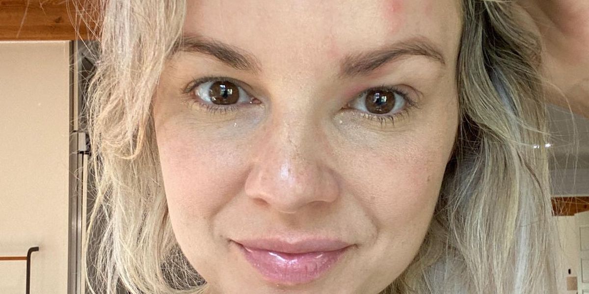 Ali Fedotowsky Is Sharing Photos of Her Shingles Rashes to Help Others ...