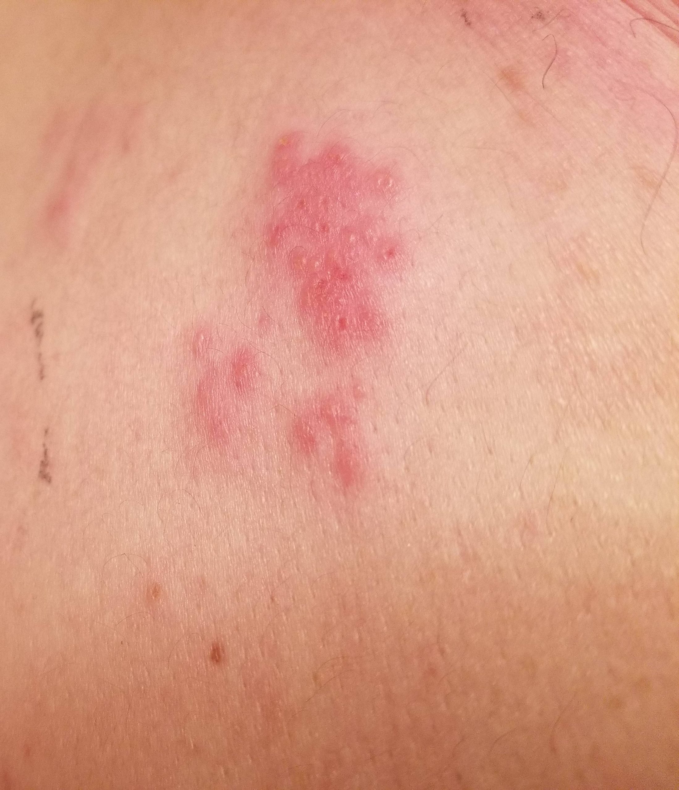 Are these hives or shingles ?? Pl tell really scared ...