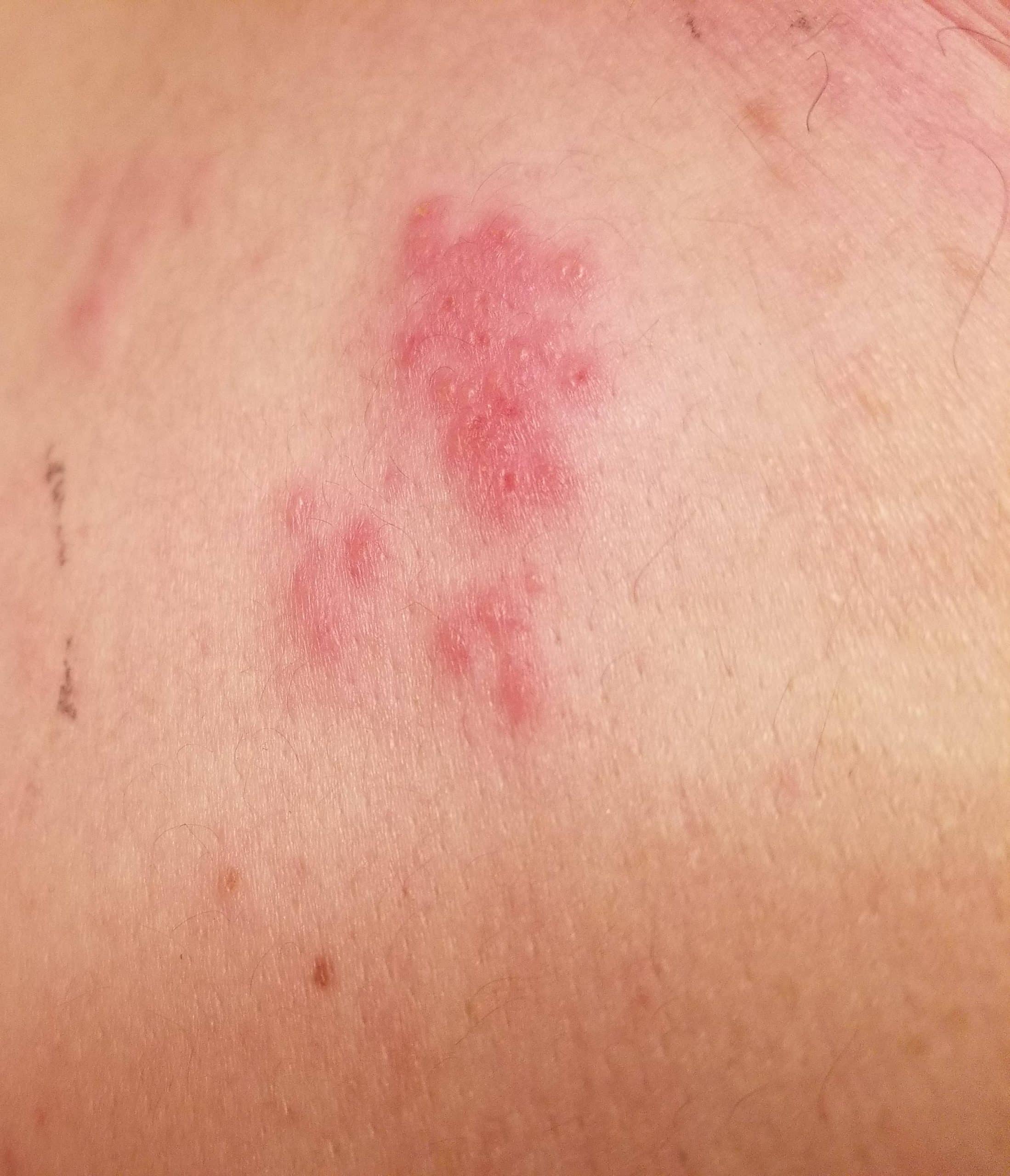 Are these hives or shingles ?? Pl tell really scared : shingles