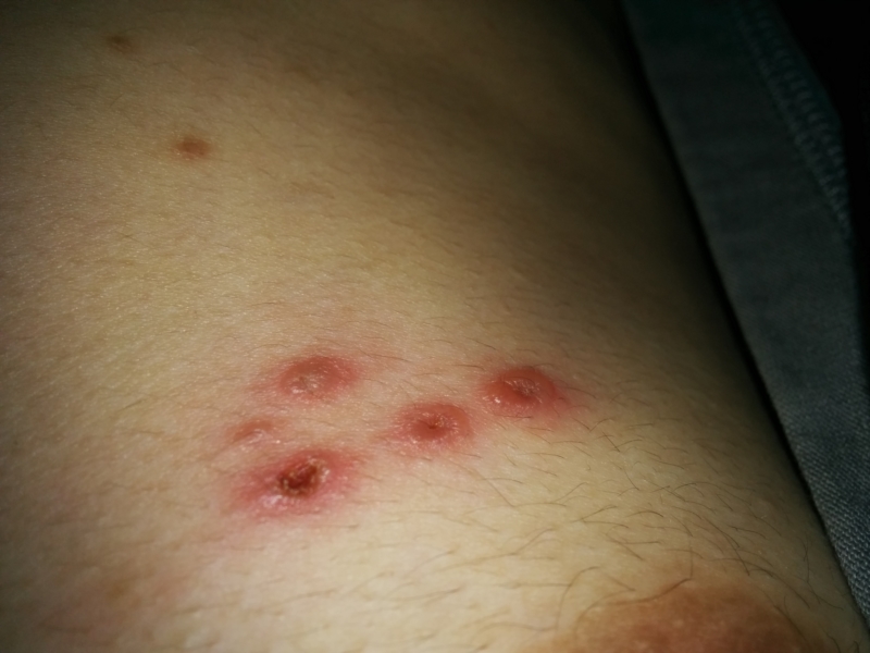 Are these shingles? Too late too use medicine?