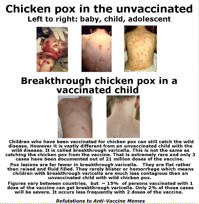 Before Vaccines: Too Close for Comfort: Rahelâs Experience with Chicken Pox