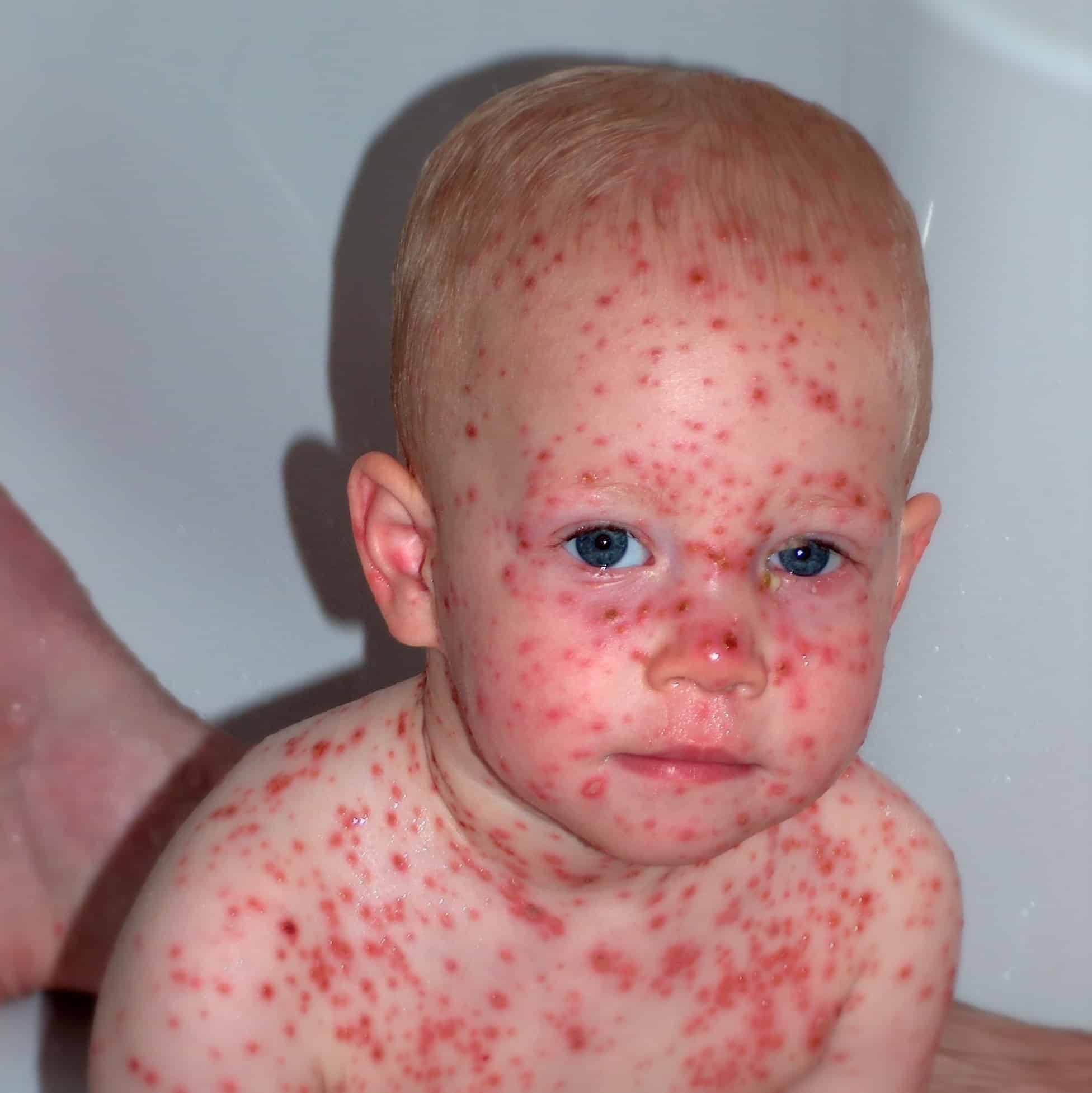Can You Get Shingles After Vaccine