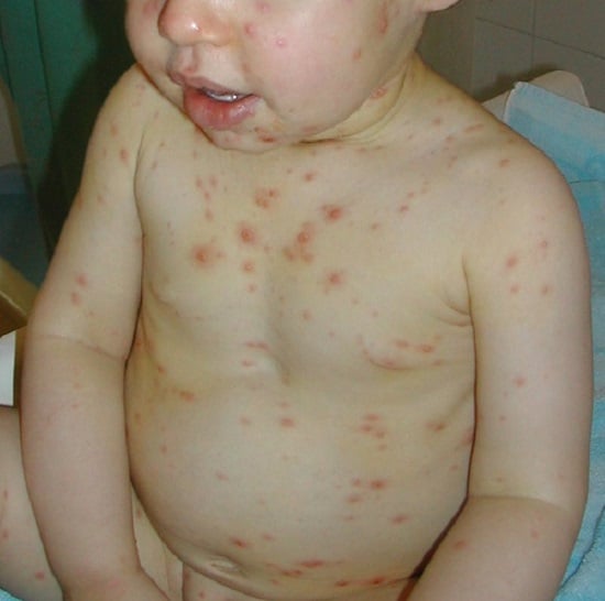 Chicken Pox in Babies Pictures  11 Photos &  Images / illnessee.com
