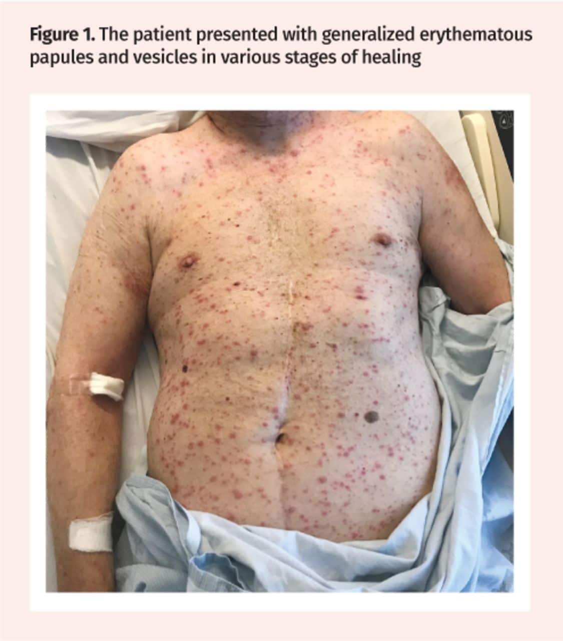 Chickenpox in an elderly man