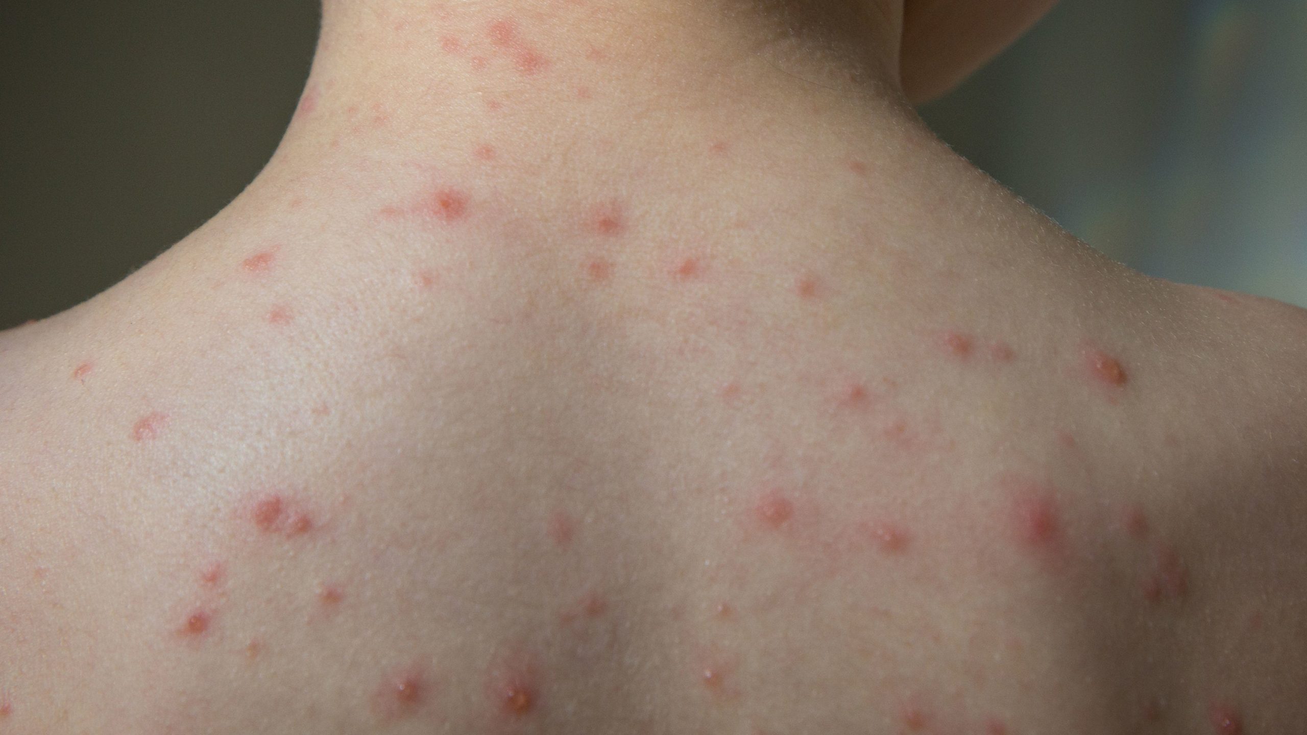 Chickenpox Outbreak at School Linked to Vaccine Exemptions