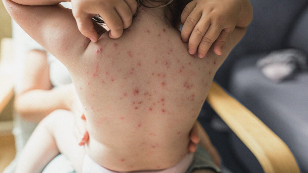Chickenpox party: Risks, vaccination, and more