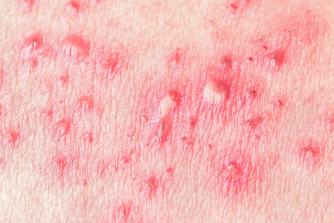 Chickenpox: Symptoms, treatment, stages, and causes