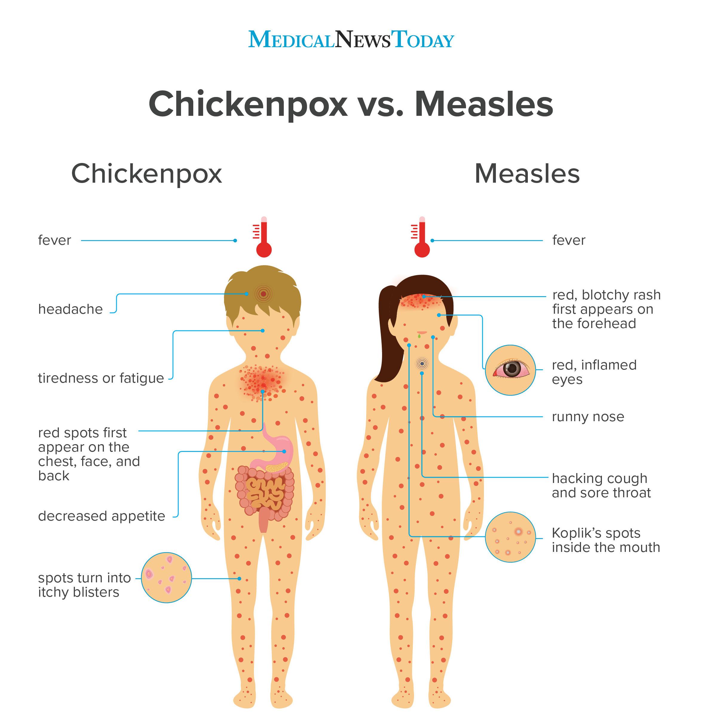 Chickenpox vs. measles: Symptoms, pictures, treatment, and more