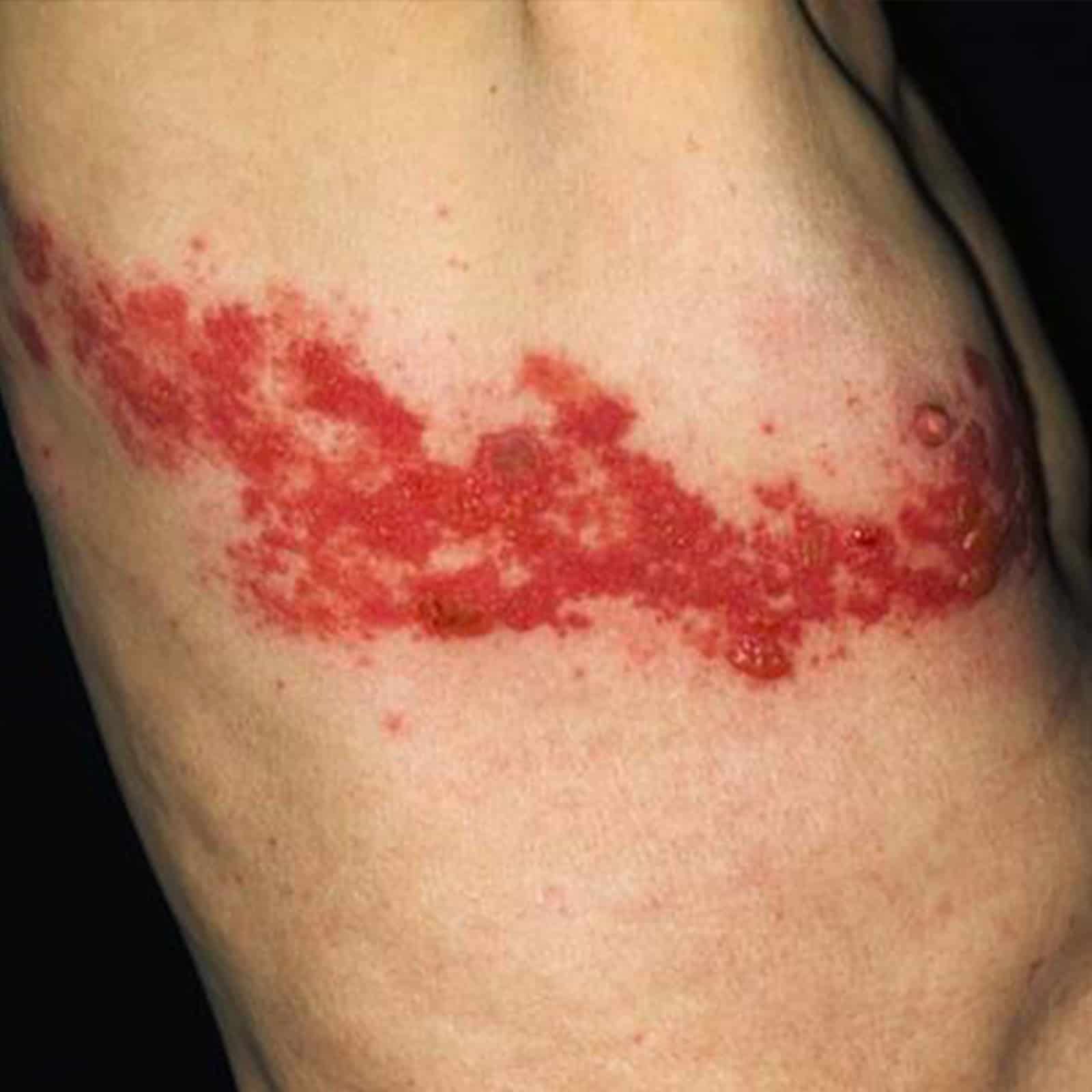 Common Skin Disease