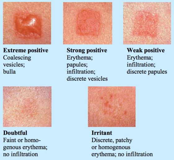 Contact dermatitis, Suddenly and Blue and on Pinterest