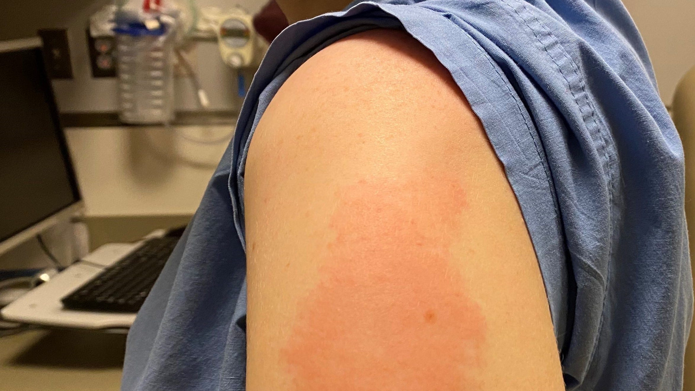 COVID vaccine side effects study: Rashes, skin reactions not dangerous