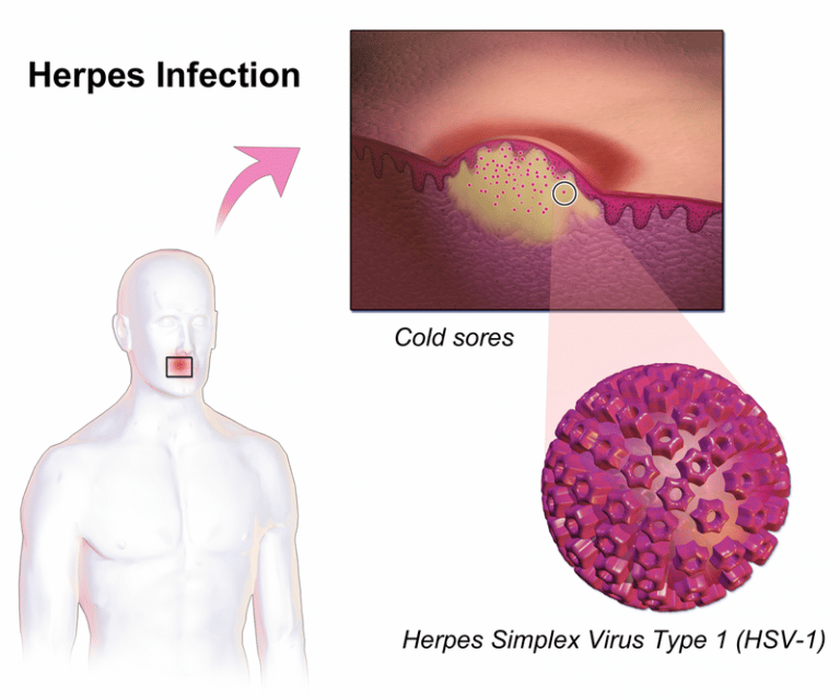 Difference Between Shingles and Herpes