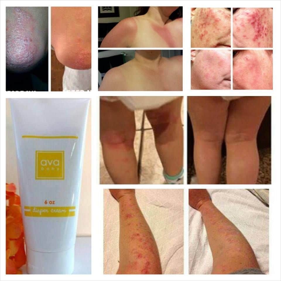 Do you have eczema, psoriasis, dry, itchy skin? Do you have unexplained ...