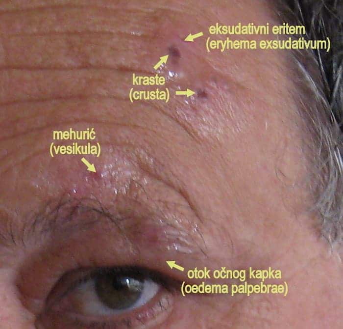 Does Shingles Affect The Eyes