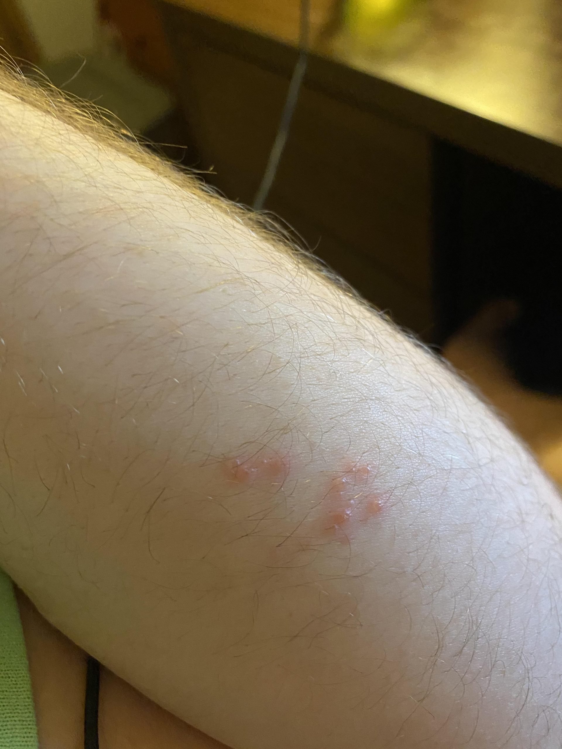 Does this look like shingles? I have it in 4 places all on ...