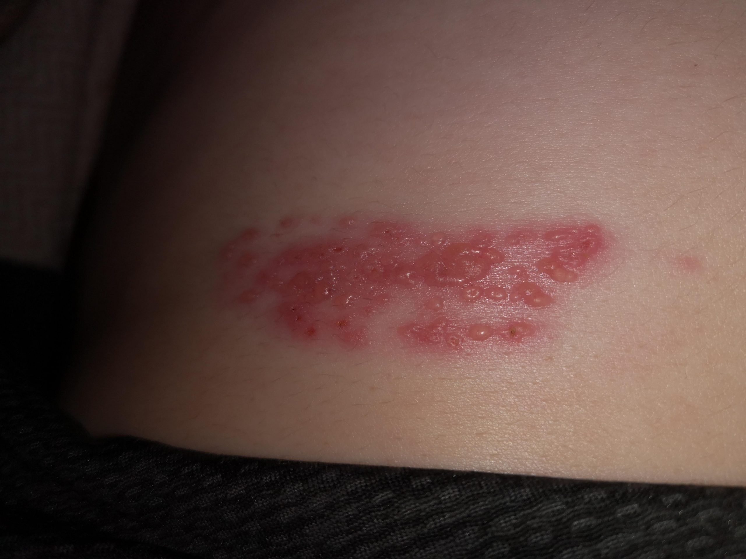 Does this look like shingles ?! I know asking medical advice on the ...