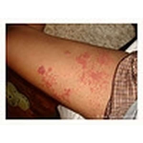 Early Signs of Shingles