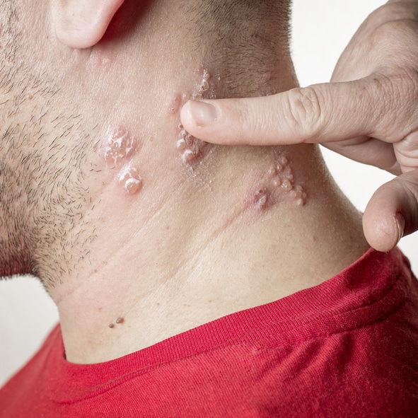 Ever Have Chickenpox? Then Youre at Risk for Shingles  Health ...