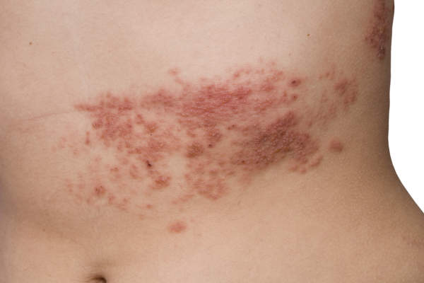 Everything You Need to Know About the Shingles Vaccine