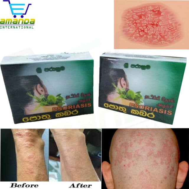 Exederm Flare Control Cream Eczema &  Dermatitis, Itching 1oz (28g) ea ...