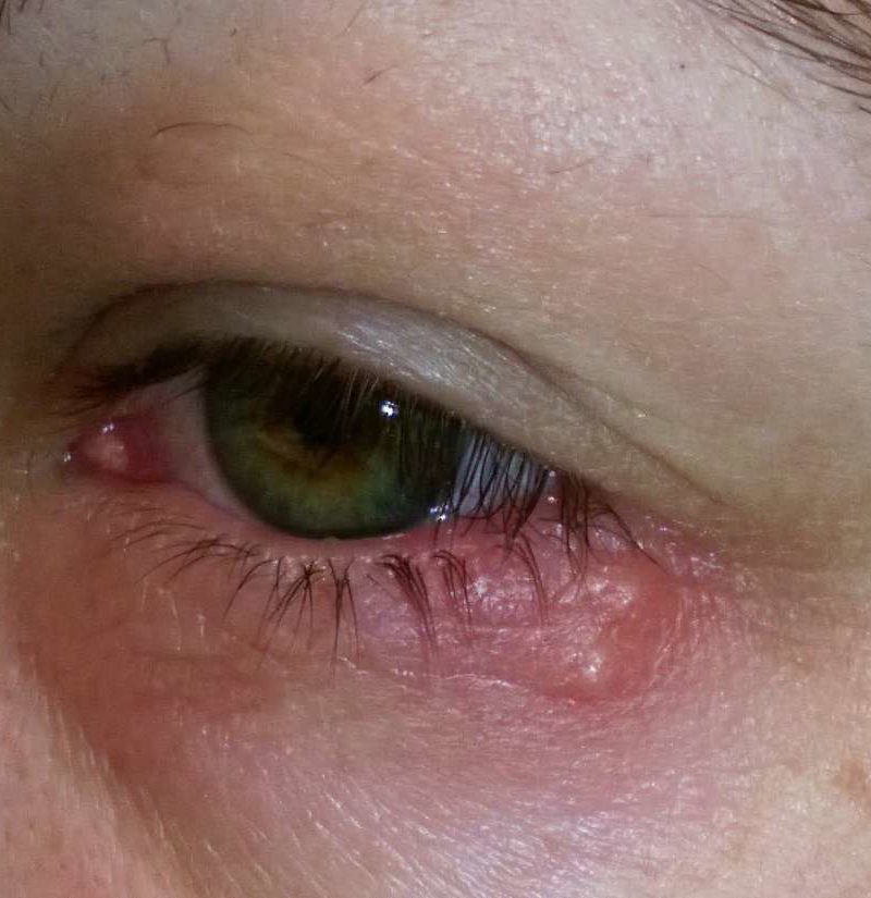 Eye herpes: Pictures, symptoms, and types