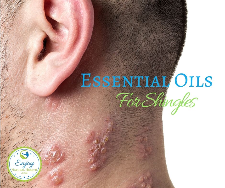 Five Best Essential Oils for Shingles
