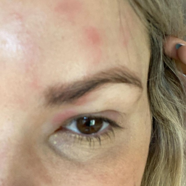 Former Bachelorette Ali Fedotowsky diagnosed with shingles