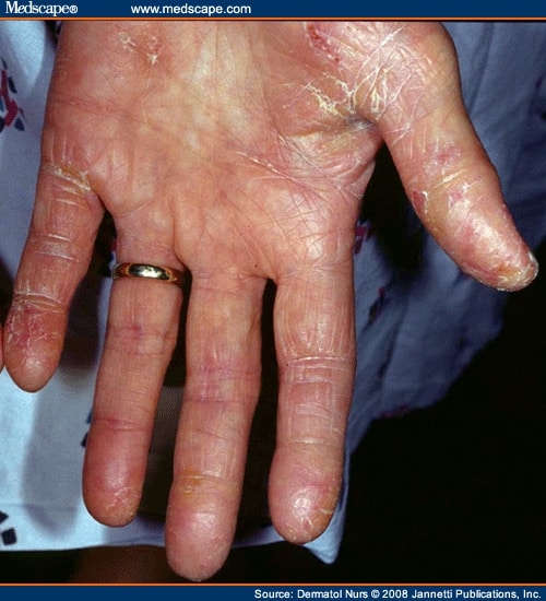 Hand Dermatitis: Clinical Features, Diagnosis, and Management