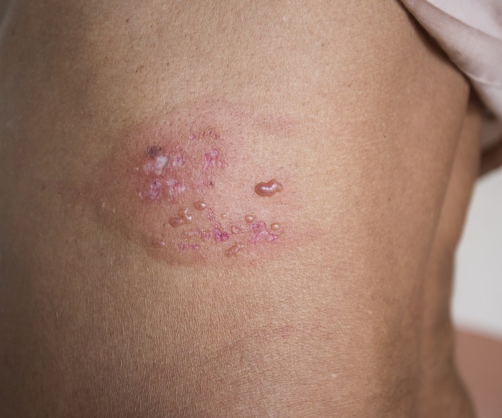 Herpes Zoster Risk Greatly Increased in Psoriasis