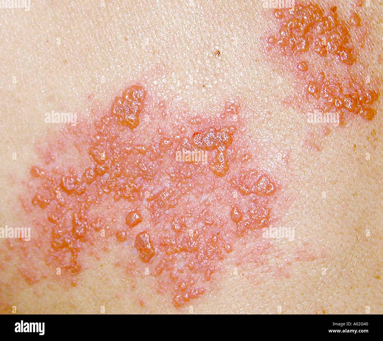 herpes zoster shingles rash Stock Photo: 3217471