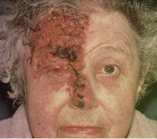 Herpes Zoster (Shingles)