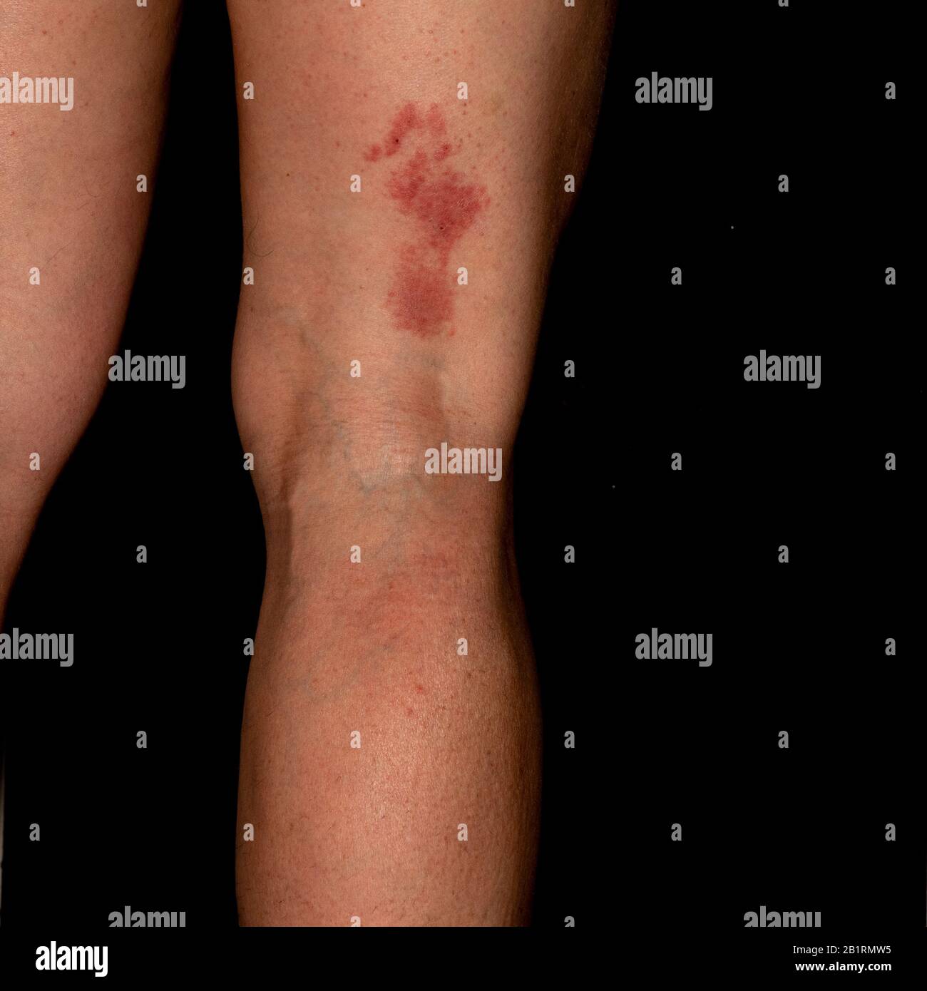 Herpes Zoster Shingles Stock Photos &  Herpes Zoster Shingles Stock ...