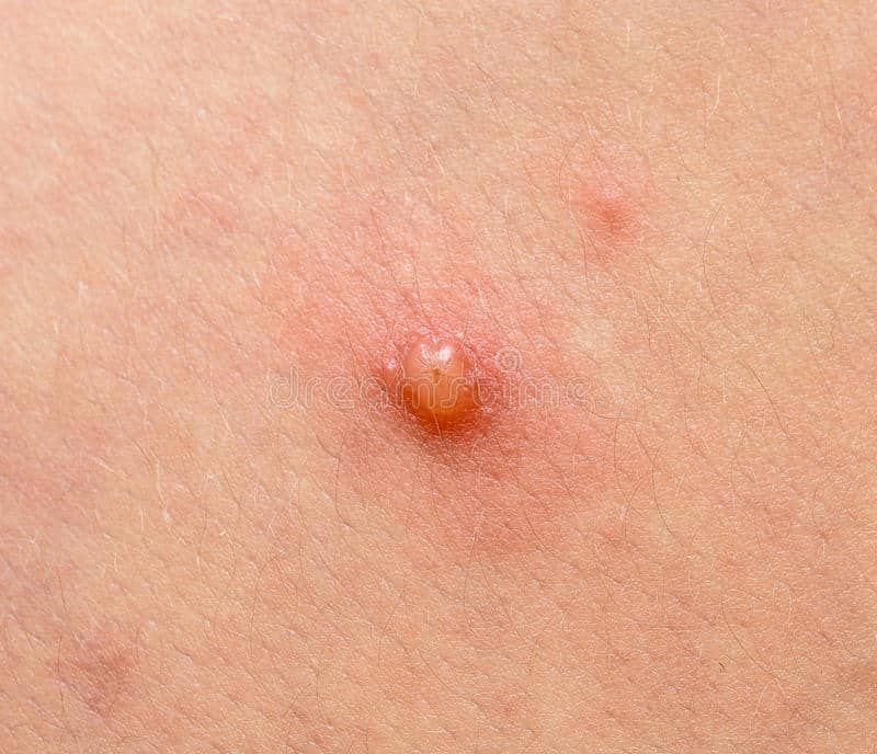 Herpes zoster stock foto. Image of epidermis, sores, bijenkorven