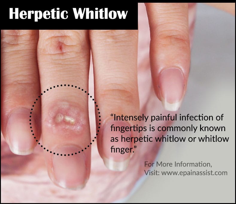 Herpetic Whitlow or Whitlow Finger