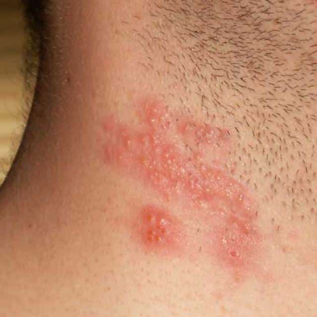 Homeopathic Treatment for Shingles