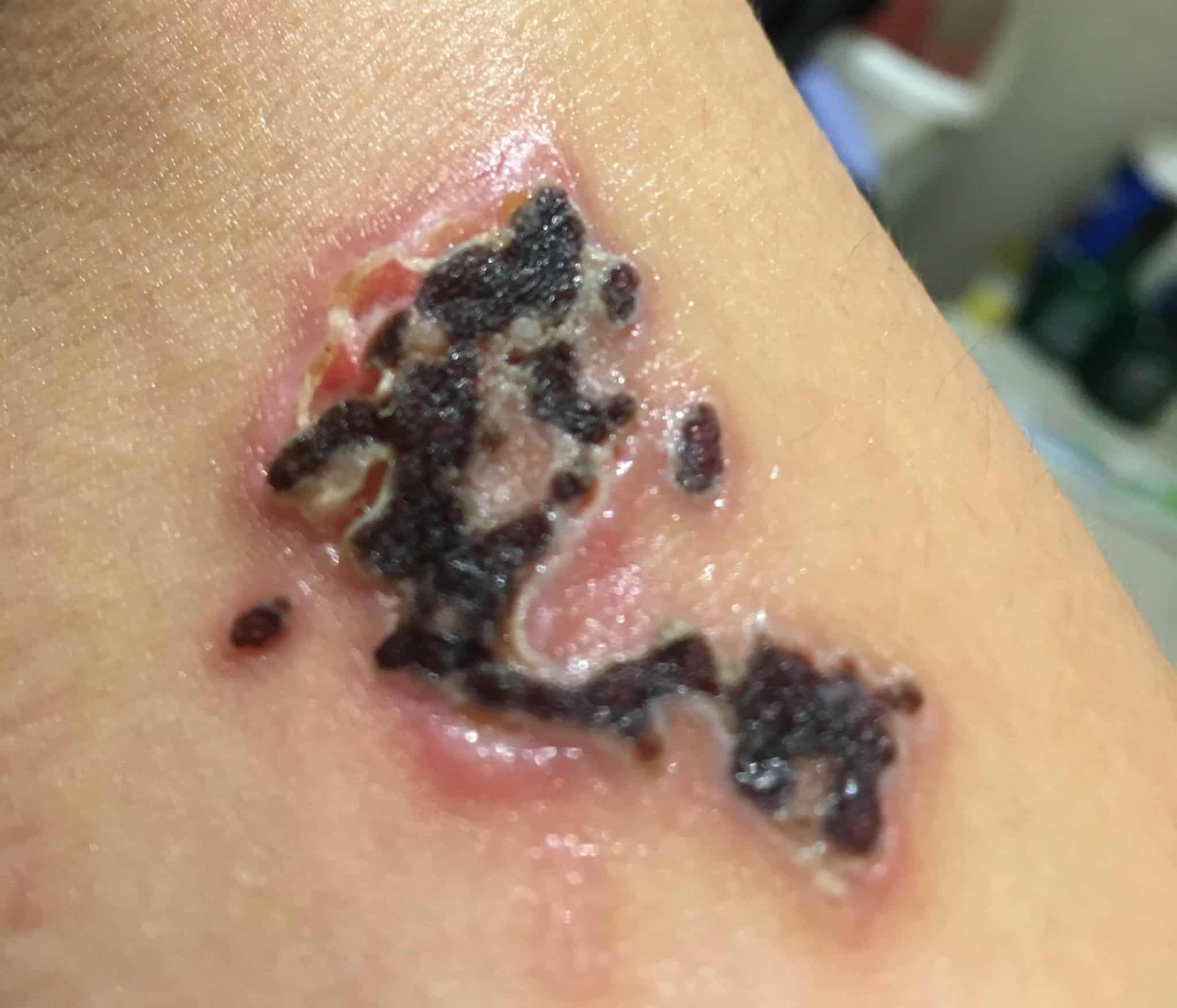 How a shingles rash becomes a hypertrophic scar  Tangled Fibres