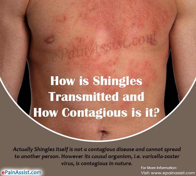 How is Shingles Transmitted, How long is it Contagious &  How Long Does ...