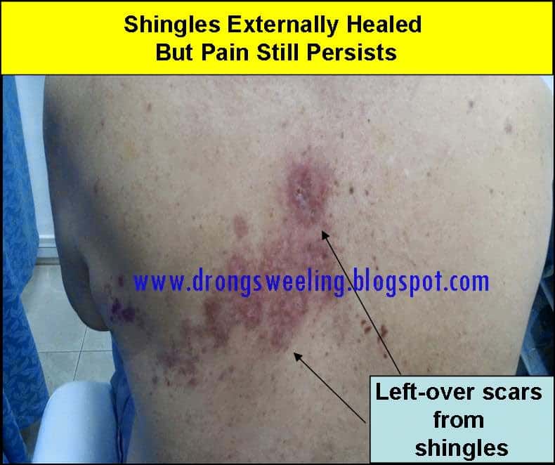 How Long Does It Take Shingles To Develop