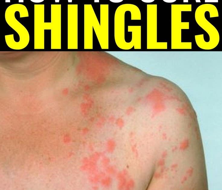 How To Cure Shingles In 3 Days Or Less, shingles remedies, natural ...