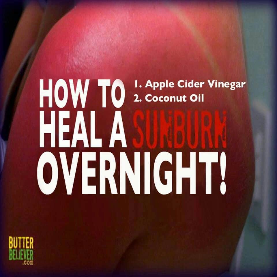 How to heal a sunburn overnight