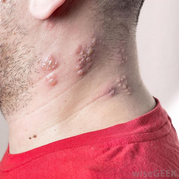How to prevent Shingles